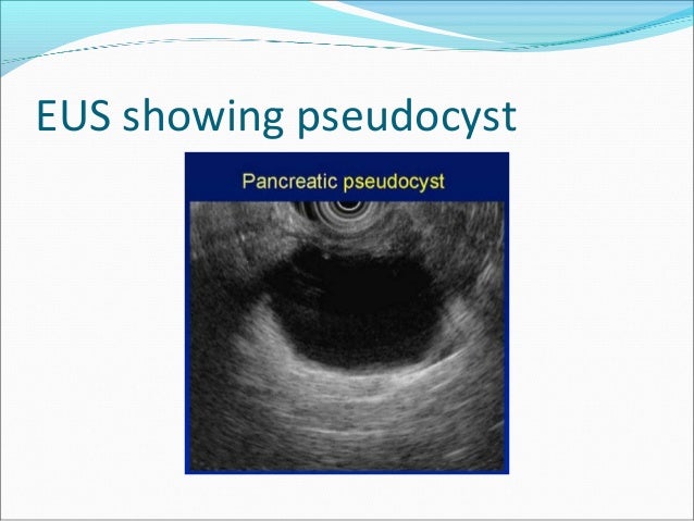Pancreatic Pseudocyst Natural Treatment Pancreatic Pseudocyst Natural Treatment