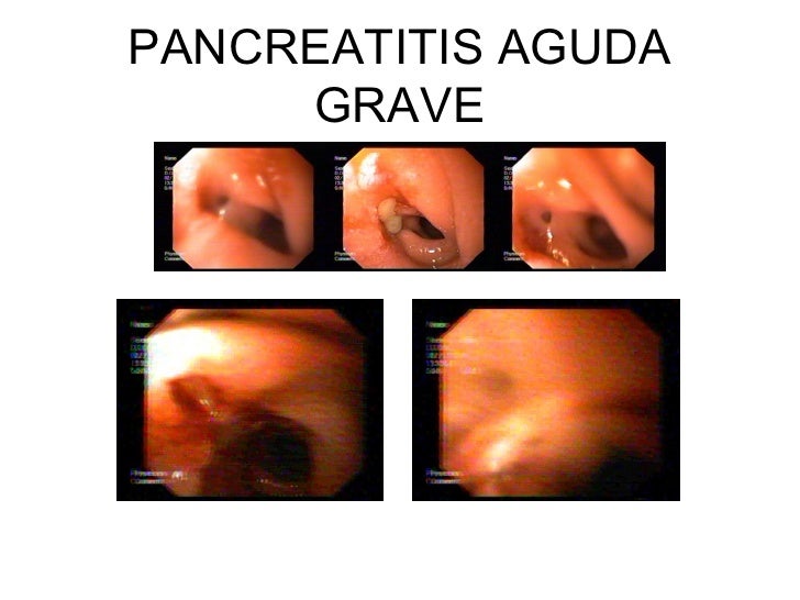 Pancreatitis Aguda Grave Necrosis Pancreatica Pancreatitis Aguda Grave Necrosis Pancreatica