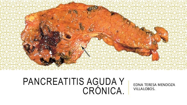Pancreatitis aguda y cronica Pancreatitis aguda y cronica
