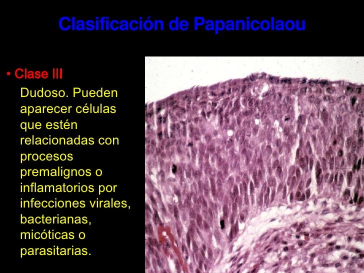 stage 4 cervical most cancers blog cervical ectropion treatment cautery