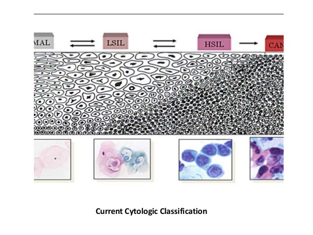 Cervical cancer Biomarkers