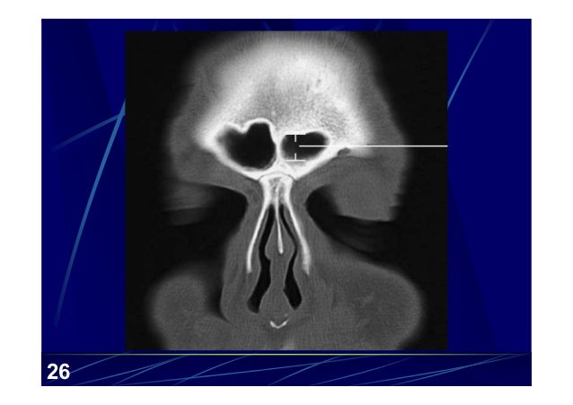 Sphenoid Sinus Pneumatization Age
