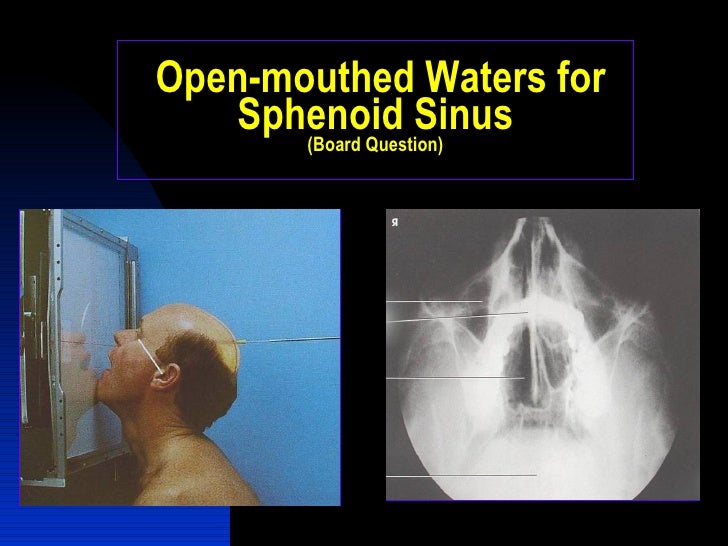 Paransasal Sinuses Home Edition