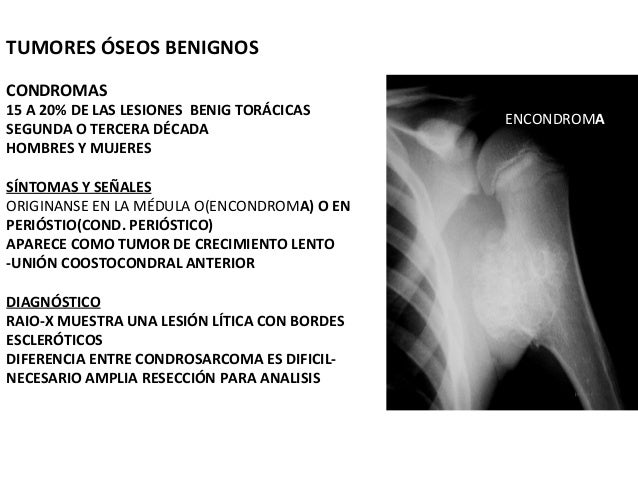 Mesotelioma En Jovenes