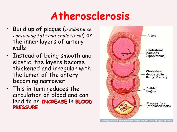 Discussion on this topic: How Dangerous Is an Aneurysm, how-dangerous-is-an-aneurysm/ Discussion on this topic: How Dangerous Is an Aneurysm, how-dangerous-is-an-aneurysm/