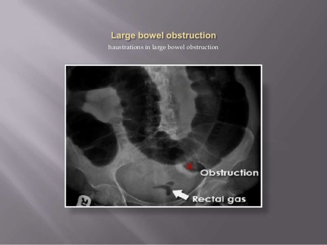 severe constipation after colonoscopy severe constipation after colonoscopy