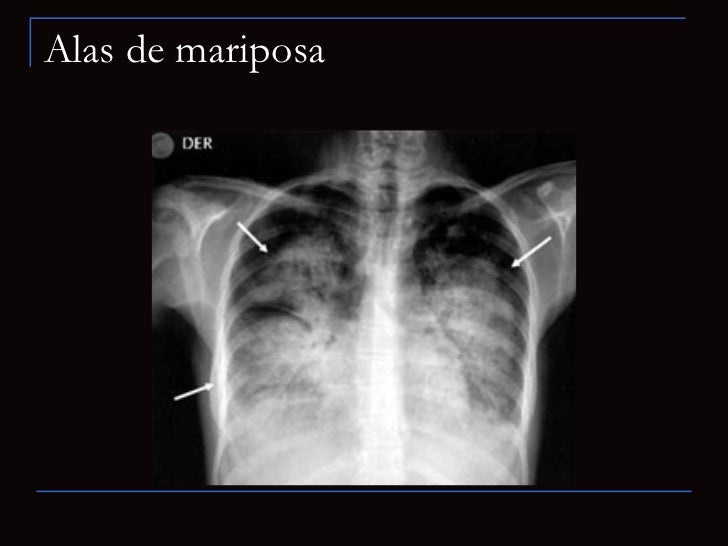 PatologíA Del Espacio Alveolar