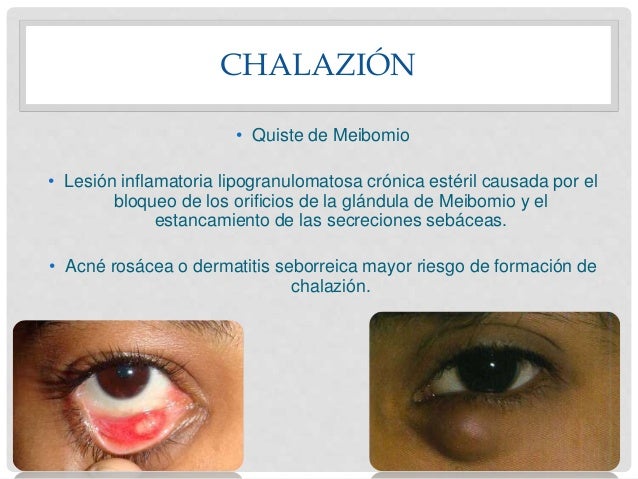 Que luchar con los granos de adolescentes sobre la persona