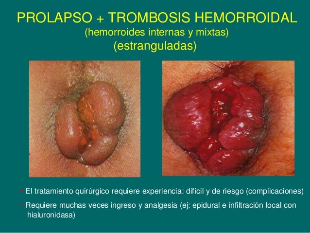 La trombosis de la causa y la profiláctica