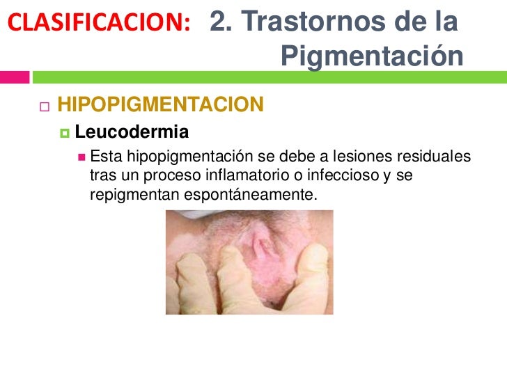 Como quitar las manchas de pigmento de las manos