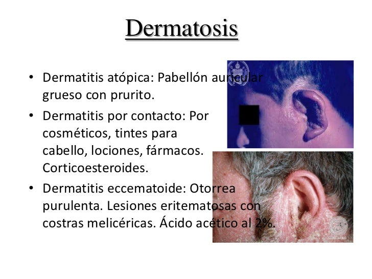 Como librarse de psoriaznyh blyashek sobre la cabeza
