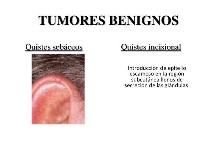 tumore benigno allo stomaco