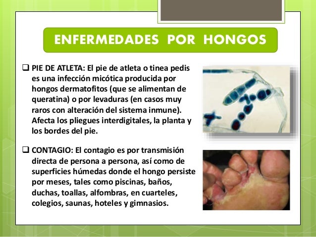 Los rasgos del hongo en los pies