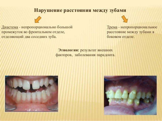 Нарушение расположения зубов Дистальный прикус (прогнатический) - что это такое, фото до и