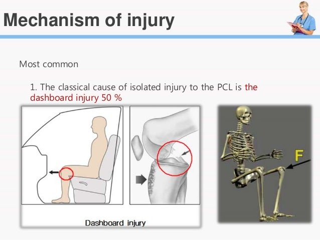 Acl ache tear anterior cruciate ligament functional anatomy