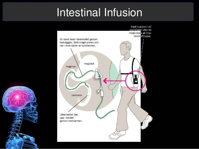 Parkinson's Disease Presentation Parkinson's Disease Presentation