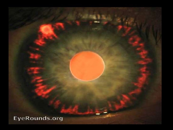 Pigment Dispersion Syndrome & Pigmentary