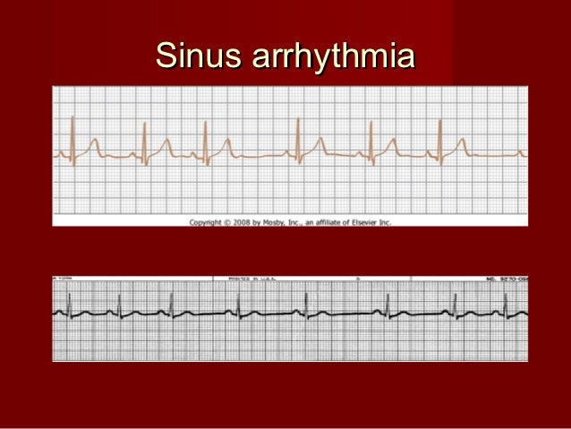 Pediatric dysrhythmias