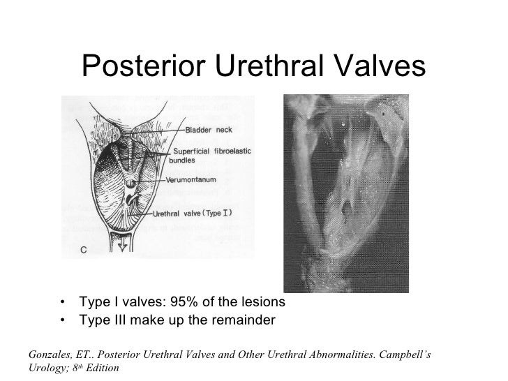 PEDI GU REVIEW lower tract i