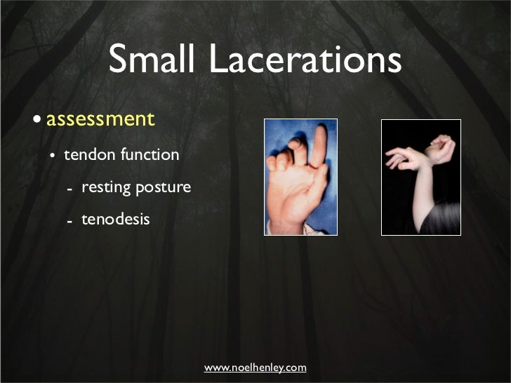 Pediatric Hand Injuries Evaluation, Diagnosis