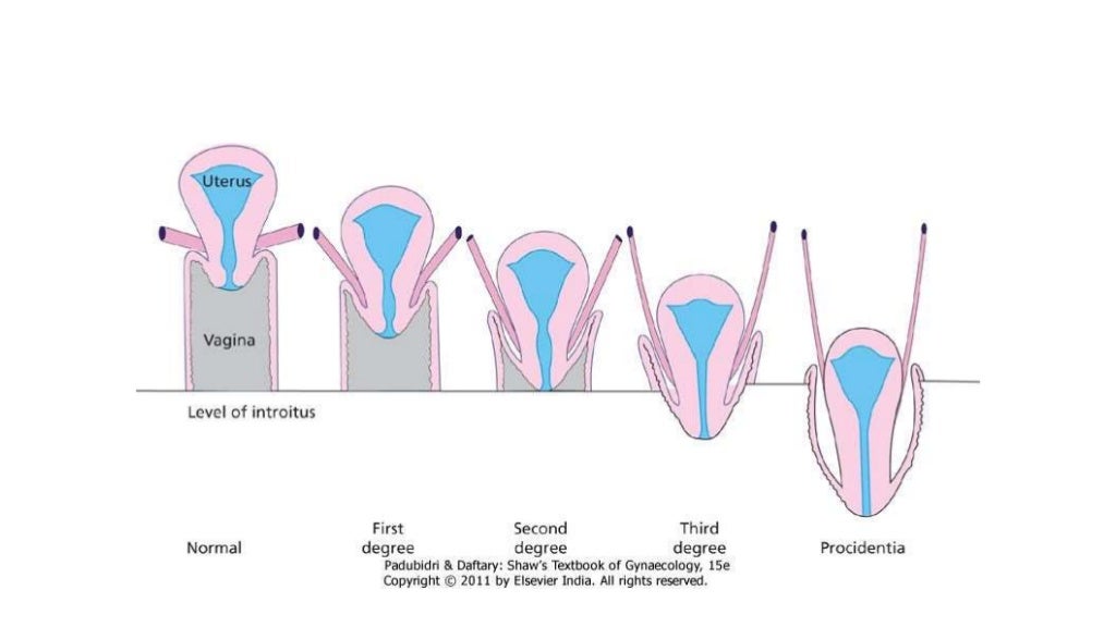Prolapsed cervix photos