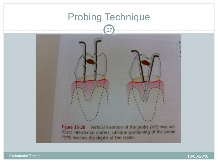 Periodontal probes