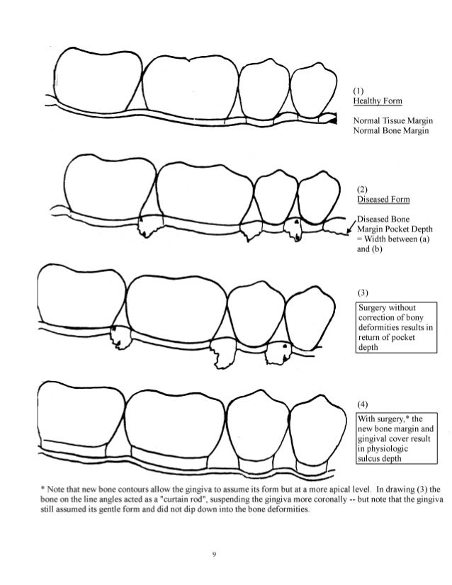 Periodontal surgeries