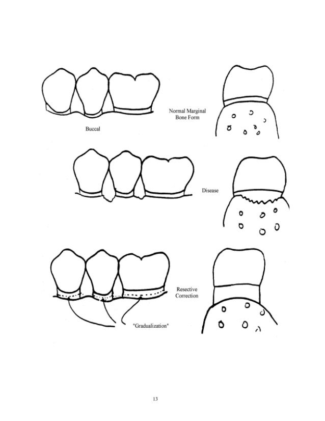 Periodontal surgeries