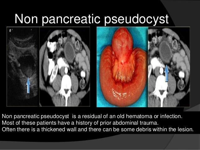 asbestos poisoning claims