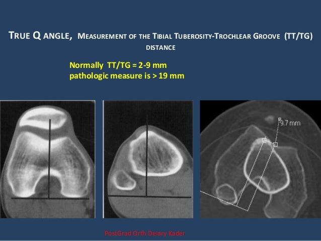 mri of knee