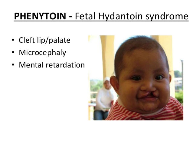 Thalidomide - Thalidomide Thalidomide - Thalidomide