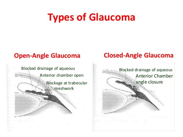 Acute Angle Closure Glaucoma Natural Treatment Acute Angle Closure Glaucoma Natural Treatment