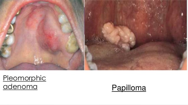Tis Cervical most cancers remedy