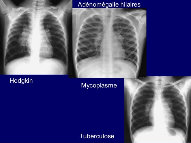 Lymphome Leucémie Différence