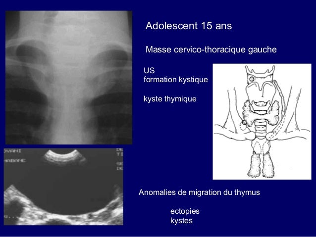 Lymphome Médiastinal