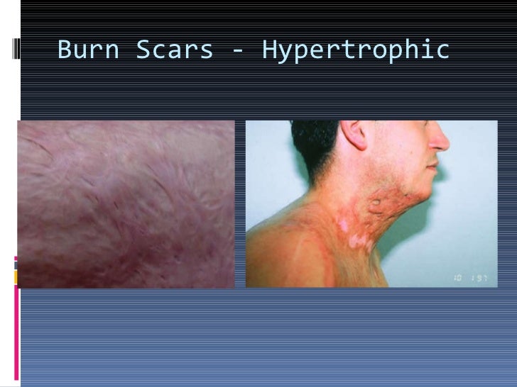 2nd degree burn scarring 2nd degree burn scarring