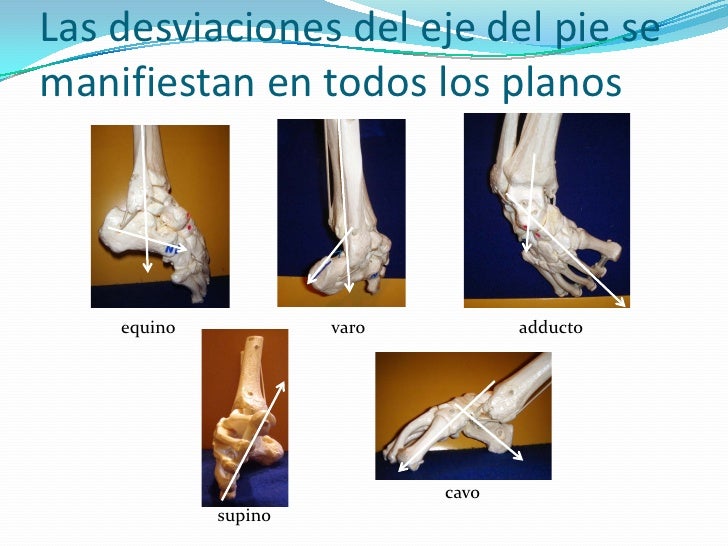 Pie Bot Información a la Familia