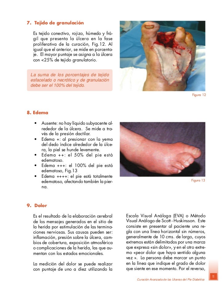 Pin Tratamiento-pie-diabetico on Pinterest Pin Tratamiento-pie-diabetico on Pinterest
