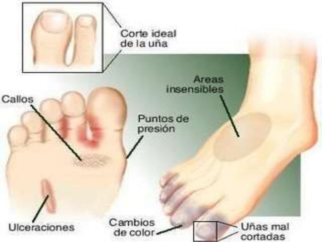 Tolstyanka cura el hongo de las uñas