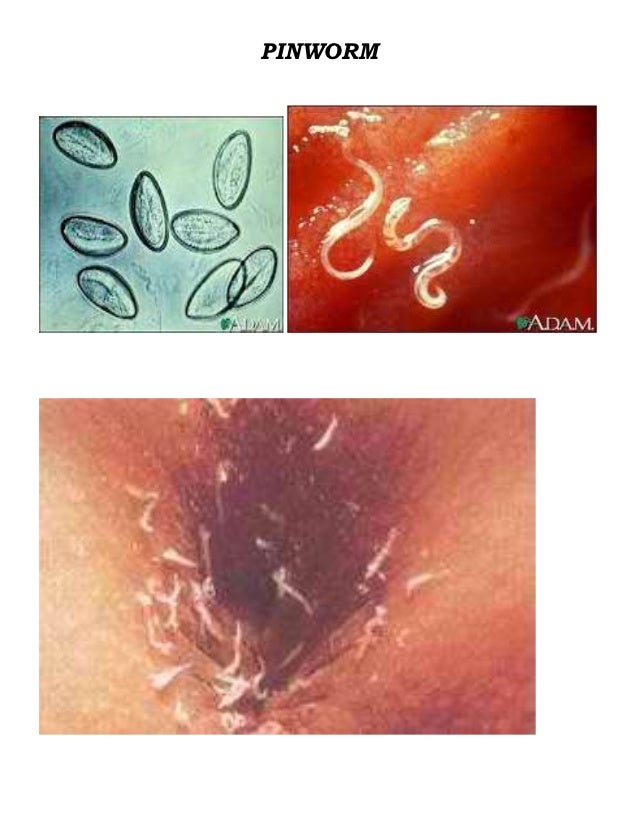 pinworm