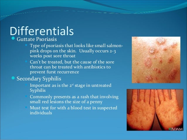 Pityriasis Rosea Treatment & Management: Approach ...