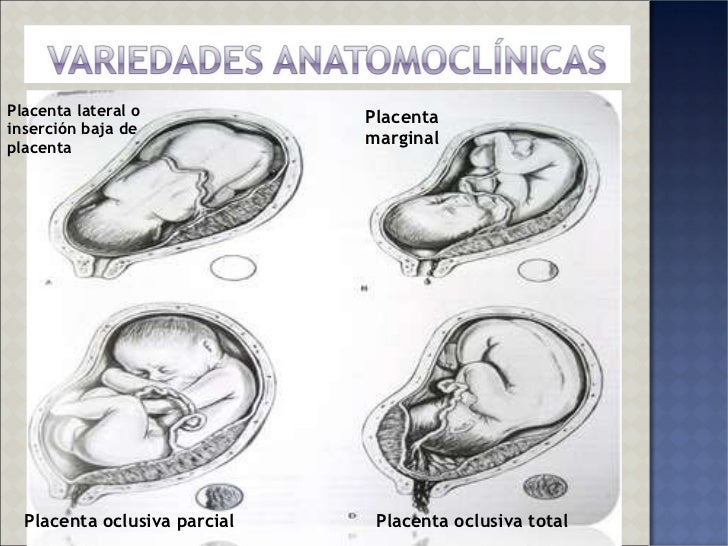 Placenta Previa