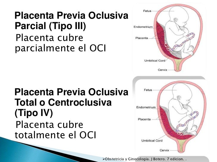 Placenta previa, abruptio de placenta Placenta previa, abruptio de placenta