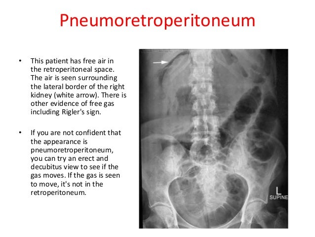 distended stomach in diabetic coma x ray distended stomach in diabetic coma x ray