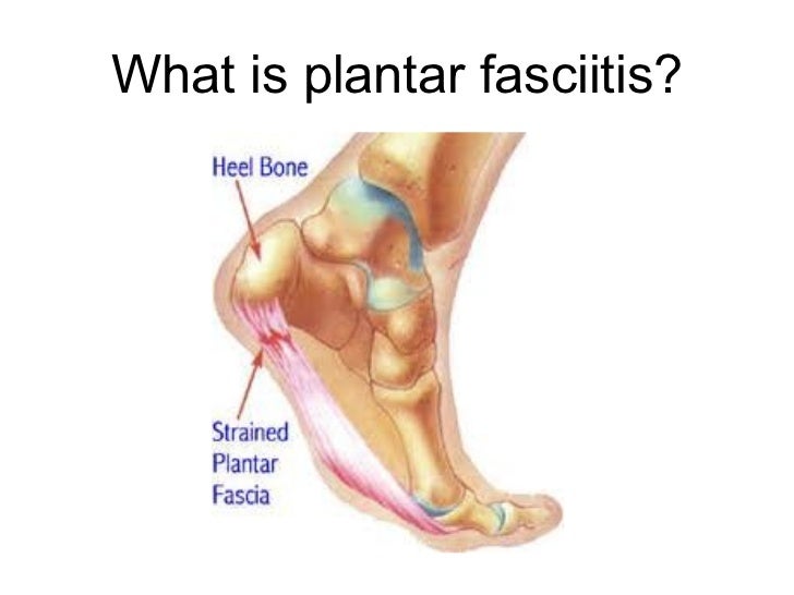 Plantar Fasciitis