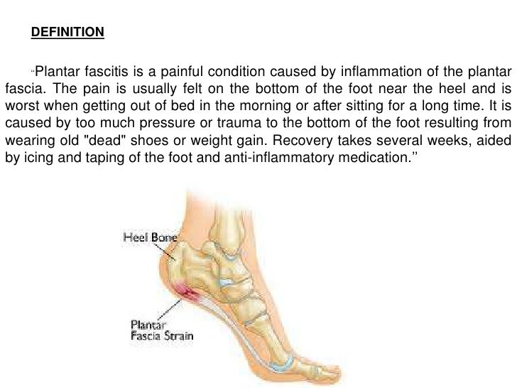 Plantar Fasciitis