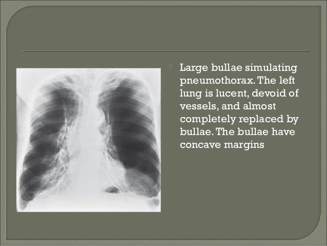Tumor Pleural