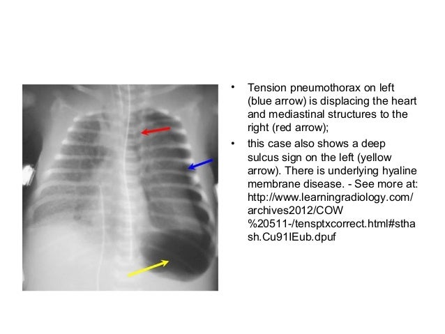 peritoneal mesothelioma wiki