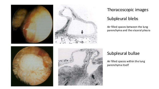 Pneumothorax case based