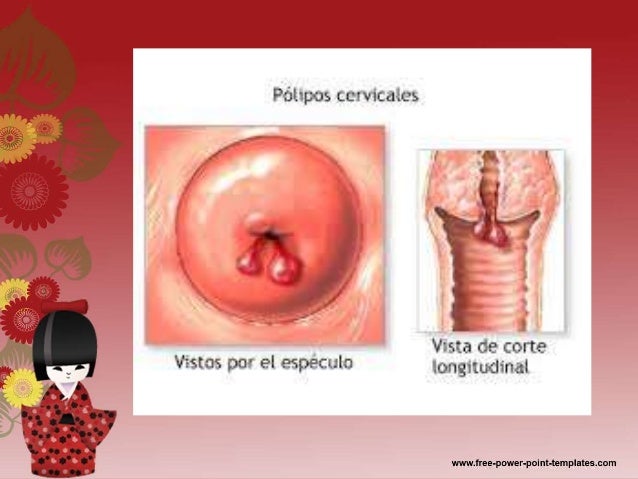 Foremost signs and signs of cervical most cancers cervical cancer treatment ranges
